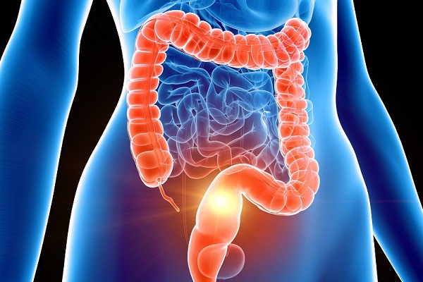 Cancer du colon (1ère partie)