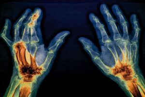 Lire la suite à propos de l’article Des traitements prometteurs contre l’arthrose (partie 2 Un médicament à l’essai)